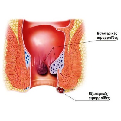 Αιμορροΐδες: Τι είναι; Ποια τα αίτια; Τι θεραπείες υπάρχουν;
